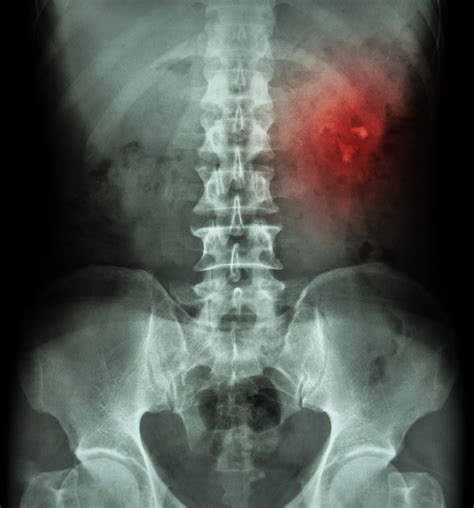 Abdomen (KUB view) .